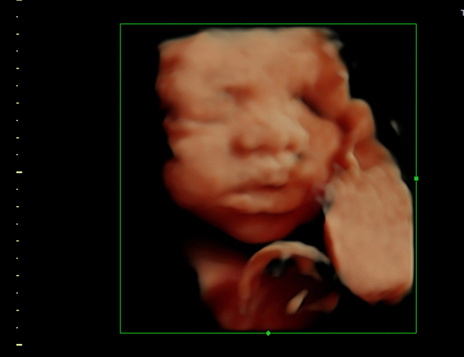 3D ultrasound image at 30 weeks